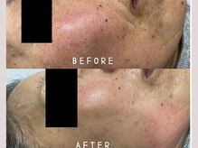 コンフィ(Comfy)/保湿・美白コース