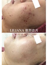 リリアーナ(LILIANA)/ハーブピーリングでニキビケア