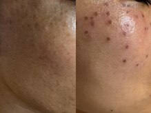 サラグランデ(Sara Grande)/シミケア施術前→施術後