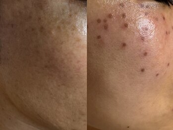 サラグランデ(Sara Grande)/シミケア施術前→施術後