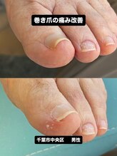 巻き爪じゅん 千葉駅前店/専門施術で快適な歩行を取り戻す