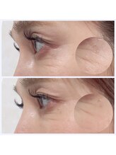 ブレア(Blair)/アルジルリン×LED光