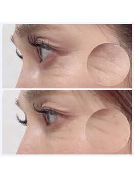 ブレア(Blair)/アルジルリン×LED光