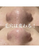 ミラーヴ(MERAVE)/毛穴エクストラクションお顔脱毛