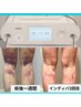 特典付♪《ER200インディバ術前/術後》1～2部位顏/ボディ腰/太腿/二の腕120分