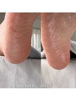 フットミー(foot mii)/