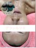 リジュラン（スキンブースター）５m近赤外線音響振動注入！究極うるおい肌