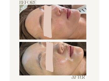 レヴ 都城店(rev)/水光ピールbefore after