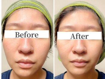 ハリニーク 銀座店(HARINIQ)/美容鍼before→after