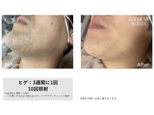 レア(Le'a)/【ヒゲ脱毛】