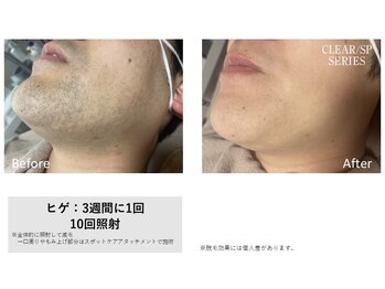 レア(Le'a)/【ヒゲ脱毛】