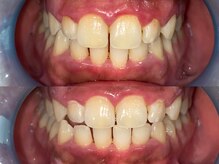 ダンブランシュサンダ(dents Blanches SANDA)/【ビフォーアフター】1回