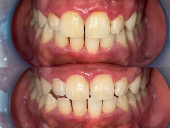 ダンブランシュサンダ(dents Blanches SANDA)/【ビフォーアフター】1回