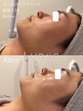 ルノン(Lunon)/毛穴洗浄ハイドロ×ララピール