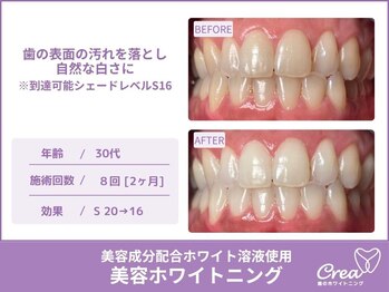 クレア(Crea)/【ホワイトニング症例写真】