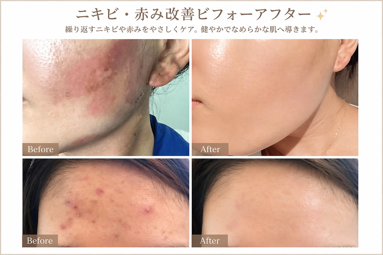 岡山県で毛穴洗浄・毛穴吸引が人気のエステサロン｜ホットペッパー