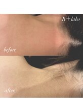 アールプラスラボ(R+labo)/WAX脱毛+美容電気脱毛☆
