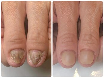 トイロ(toiro)/「トラブル爪の見た目を改善」