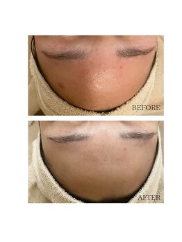 エモベーシック(e'MO BASIC)/BBLニキビケア