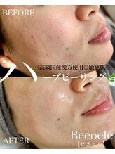 ビオエル(Bee'oele)/高級国産ハーブピーリング