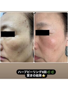 エル(Elle)/iLLON ショートカットピーリング