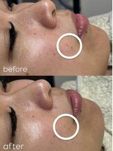 リリーラボ(LILY LAB)/一回の施術でニキビの赤み鎮静！