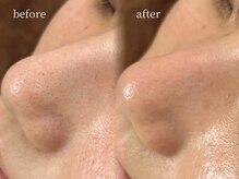 ビーグロウ(be Grow)/毛穴黒ずみスッキリ☆