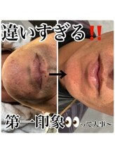 アンジー(an.g)/【御幸町脱毛】ひげ脱毛