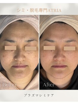 アトリア(ATRIA)/シミ改善フェイシャル