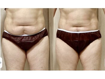 アンヘル(Angel)/軟部組織セラピー♪驚きの変化！