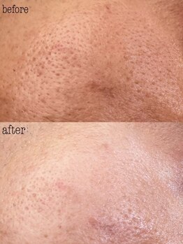 ラヴァン(LaVan)/美白&毛穴改善