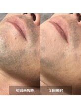 リムル(REMURU)/ひげ脱毛3回照射