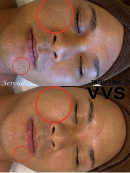 セレニテ(Serenite)/症例写真