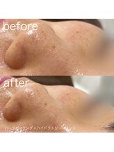 ルルラ リコ(lulula rico)/症例写真/ハイドラ毛穴洗浄