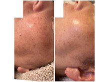 ドットフェイス(.Face)/before/after