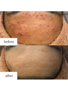 アルル(ARuru)/肌改善症例