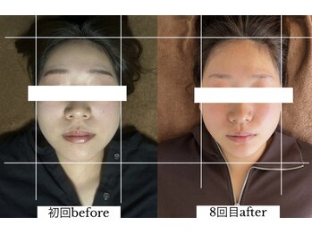 ダイアリー(DIARY)/小顔矯正