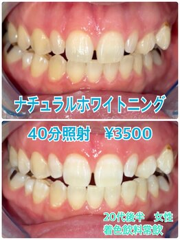 プラチナムビューティー 川口駅前店(PLATINUM BEAUTY)/ホワイトニング初回の症例写真