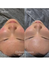 エレファンテブランコ(Elefante Blanco)/☆美白！お肌のホワイトニング