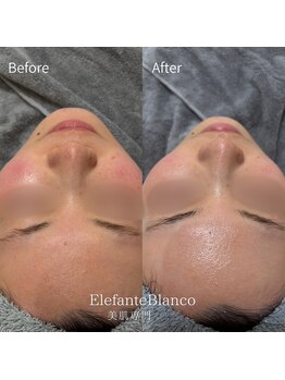 エレファンテブランコ(Elefante Blanco)/☆美白！お肌のホワイトニング
