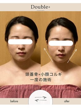ダブルプラス(Double+)の写真/【顔の歪み/左右差/むくみ解消◎】痛気持ちいい本格施術で日々の疲れを解消しながら小顔も叶います♪