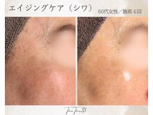 スリースリー 恵比寿(THREE THREE)/エイジングケア・しわ・たるみ