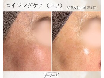 スリースリー 恵比寿(THREE THREE)/エイジングケア・しわ・たるみ