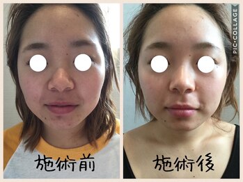 癒しの隠れ家サロン シュシュ(CHOU*CHOU)/フェイスリンパ90分施術前施術後