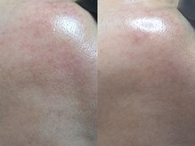 ルリノエプラスウイ(RURINOE+ui)/最新光フェイシャル★肌質改善