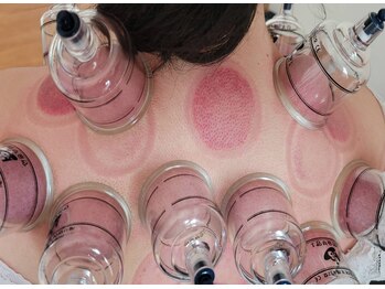 韓国 カッピング 吸い玉専門店 ラボ/肩こり撃退！部分 カッピング 