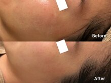 サロンヴェアリー 広尾(salon vary)/花粉荒れ赤み#白玉#水玉