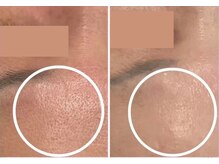 エングロー 錦糸町店(Englow)/【毛穴レス】ハーブピーリング