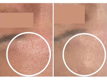 エングロー 錦糸町店(Englow)/【毛穴レス】ハーブピーリング