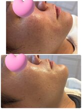 ココサロン(Coco Salon)/毛穴洗浄ビフォアフ！